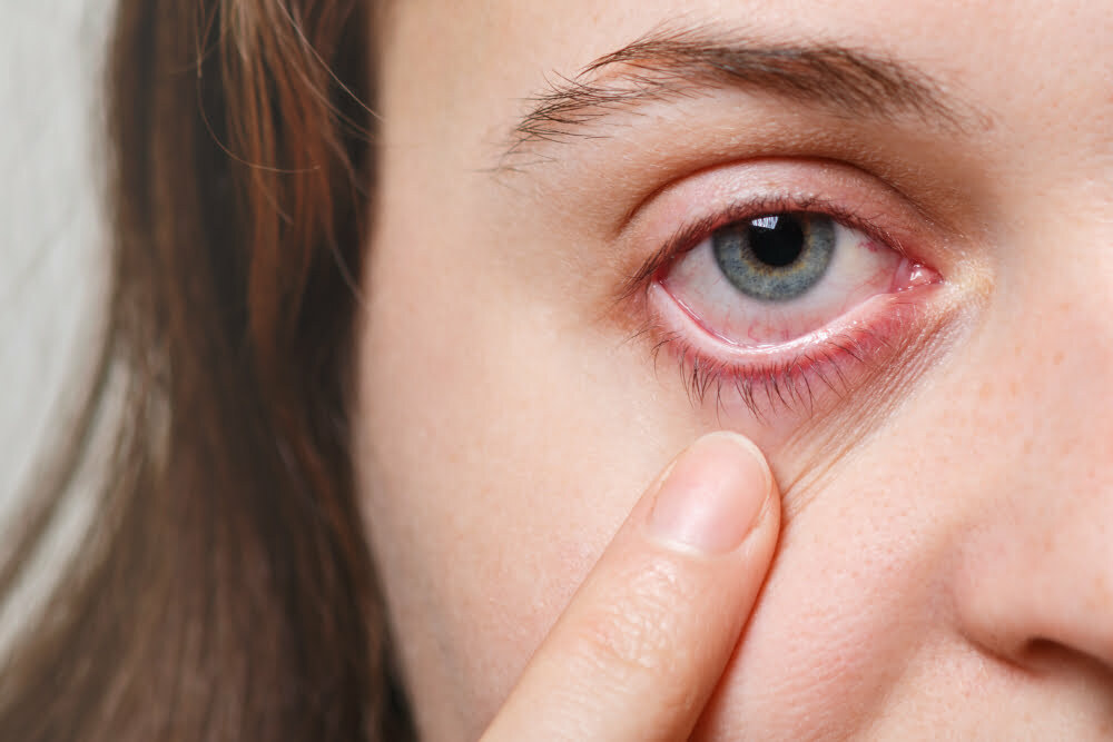 red eye due to dryness
